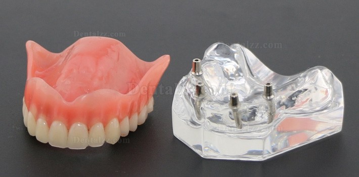 歯科教学用歯モデル上顎重塁義歯4本インプラントデモ6001